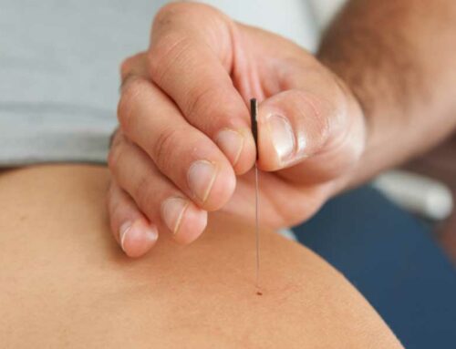 Physiotherapy and Dry needling